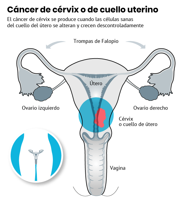 Cáncer de cérvix o de cuello uterino.