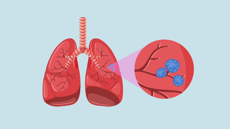 Imagen de los pulmones