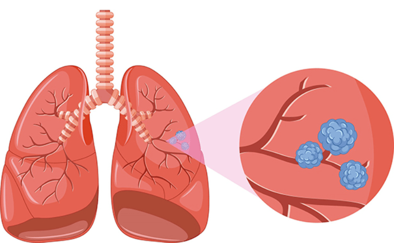 Diferencias entre el cáncer de pulmón microcítico y le no microcítico