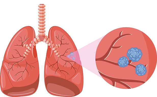Diferencias entre el cáncer de pulmón microcítico y le no microcítico