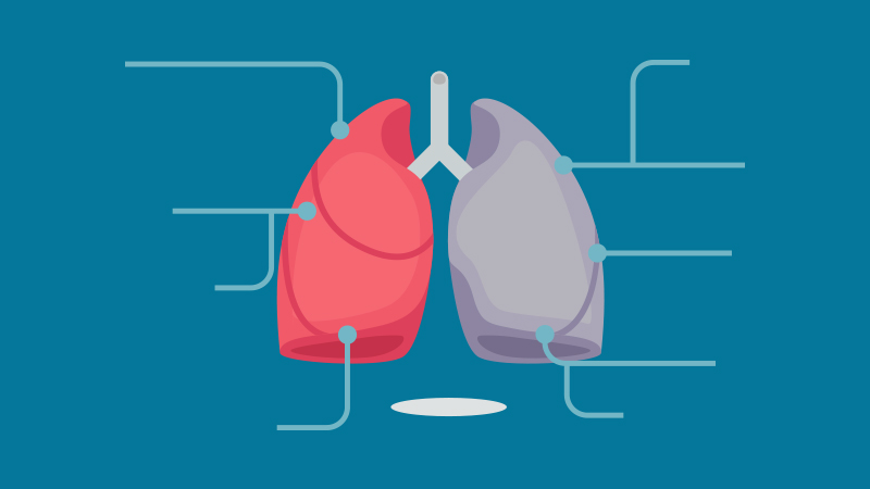 Enfermedad pulmonar intersticial