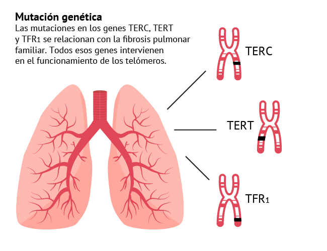 Mutación genética de la fibrosis pulmonar idiopática