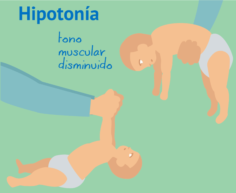 Hipotonia, Atrofia muscular